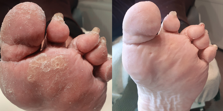 soin_pedicure_pieds_secs_callosites