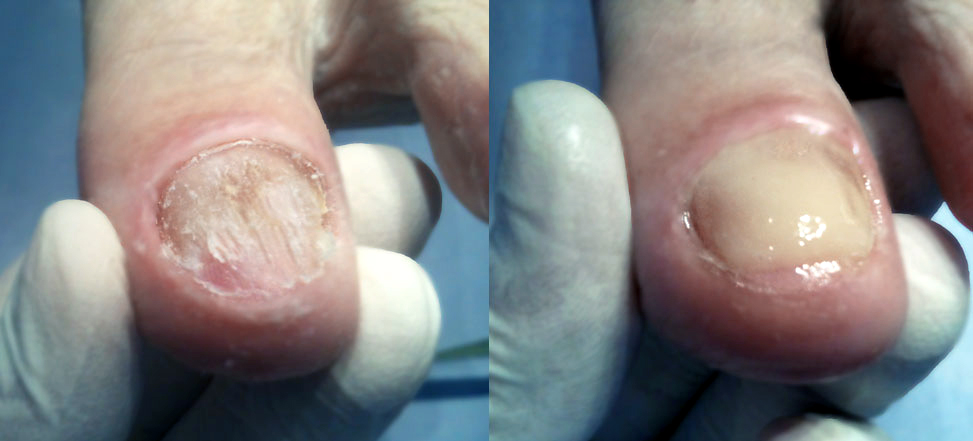 orthonyxie-pedicure-medicale