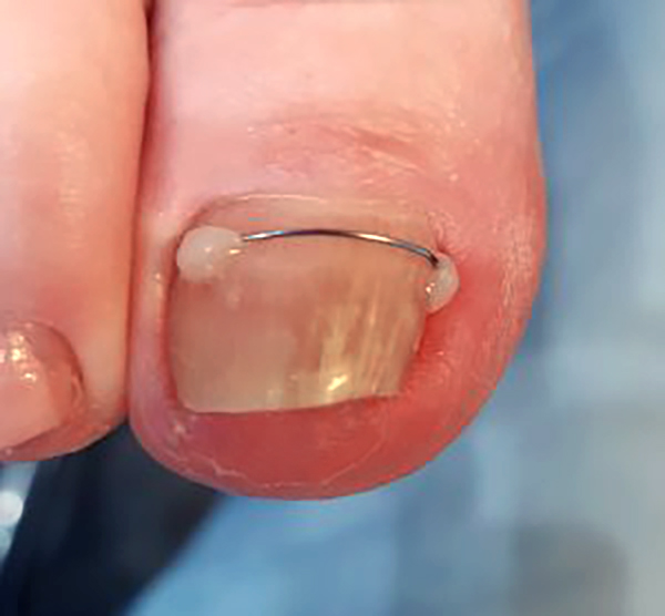 orthonyxie-pedicure-medicale